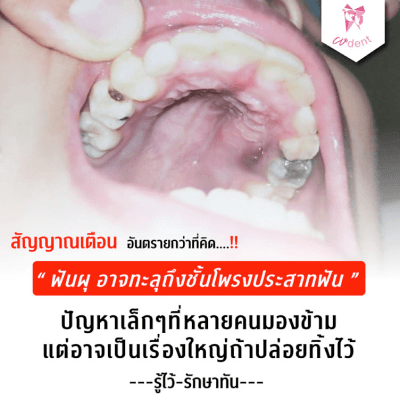 ฟันผุก็อุดสิ….. แต่จะดีกว่ามั้ย?… ถ้าเรามีฟันที่แข็งแรง