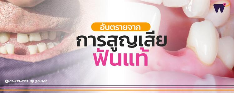 อันตรายจากการสูญเสีย “ฟันแท้”: ผลกระทบต่อโครงสร้างใบหน้า