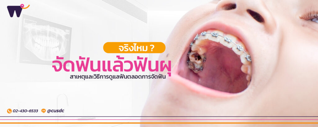 จัดฟันแล้วฟันผุ จริงไหม? สาเหตุและวิธีการดูแลฟันตลอดการจัดฟัน