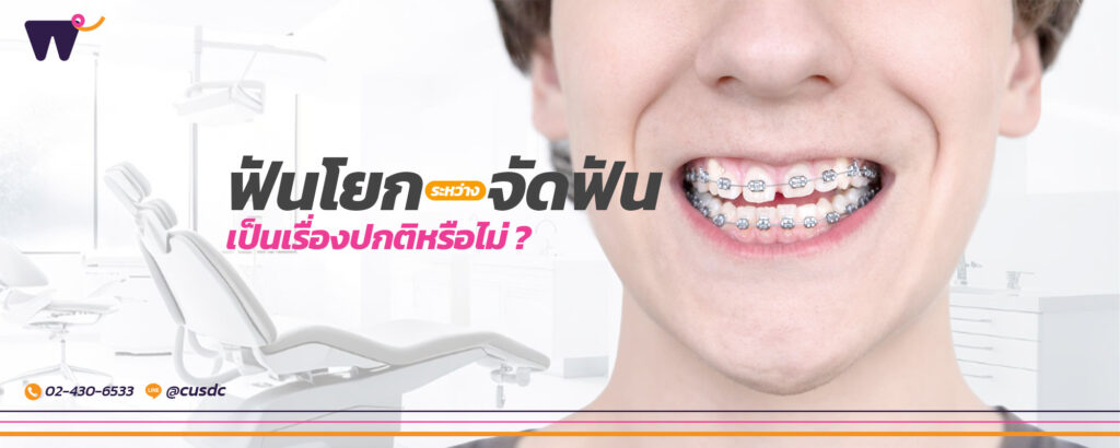 ฟันโยก ระหว่าง จัดฟัน เป็นเรื่องปกติหรือไม่? กลไกการเคลื่อนตัวของฟัน