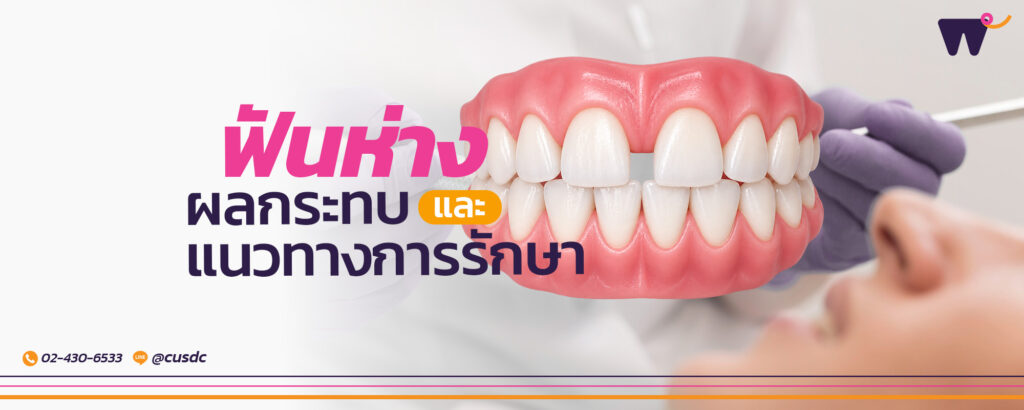 ปัญหา ฟันห่าง อาจกลายเป็นจุดเล็กๆ ที่สร้างความกังวลใจได้ ในทางทันตกรรม ภาวะนี้ยังสัมพันธ์กับสุขภาพช่องปากและการทำงานของระบบการเคี้ยวโดยตรง
